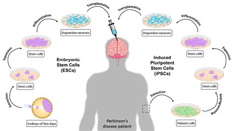 parkinson's disease and stem cell treatment